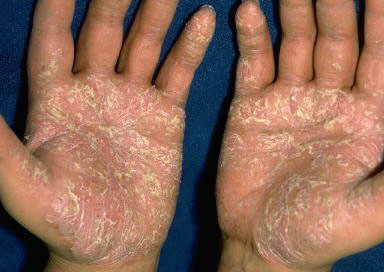 Dermatitis Pictures 